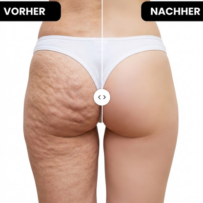 Anti Cellulite Leggings - 3D Kompression | VALENTINSTAG-SALE